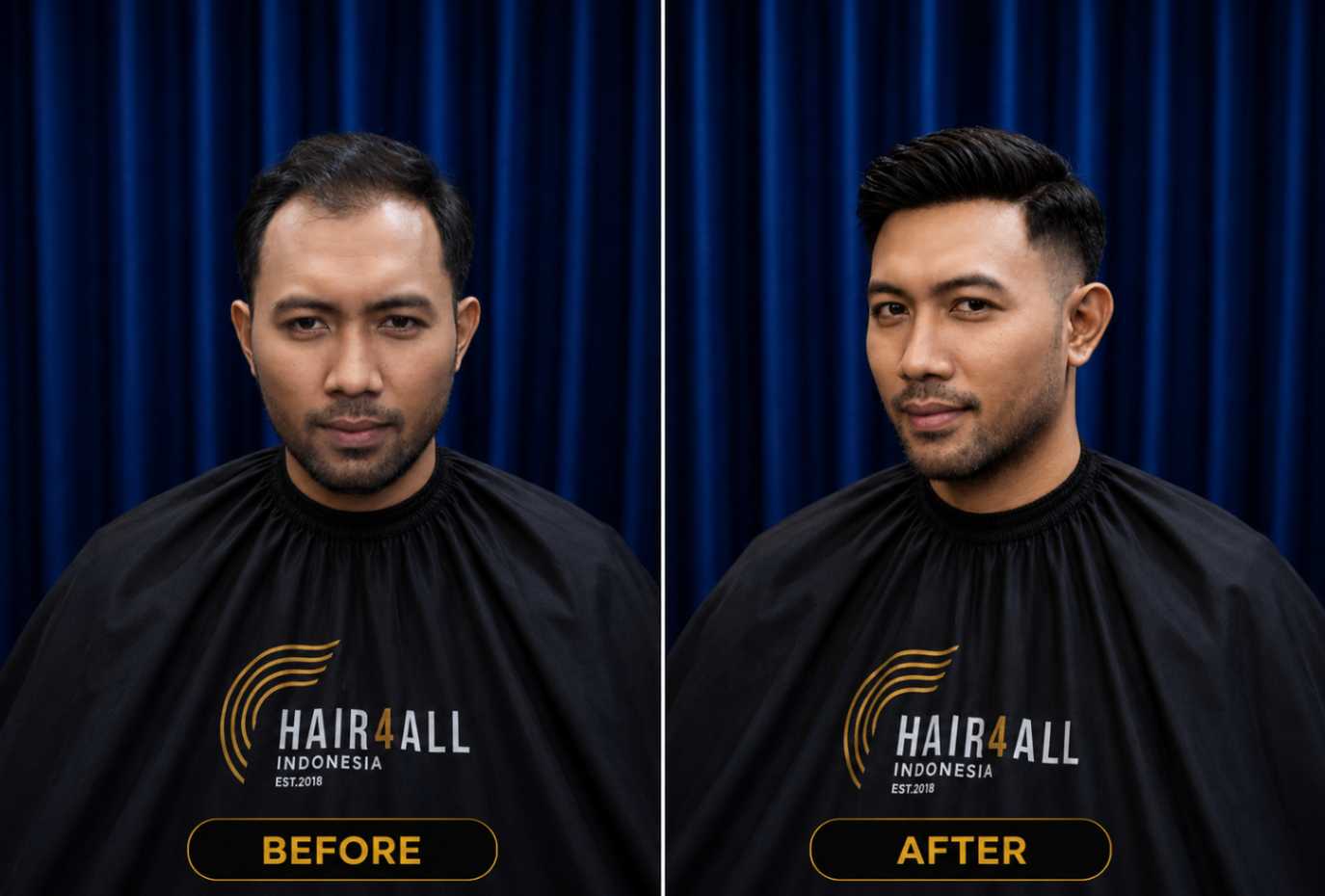 Transformasi klien Hair4All Indonesia 19 — sebelum dan sesudah hair replacement