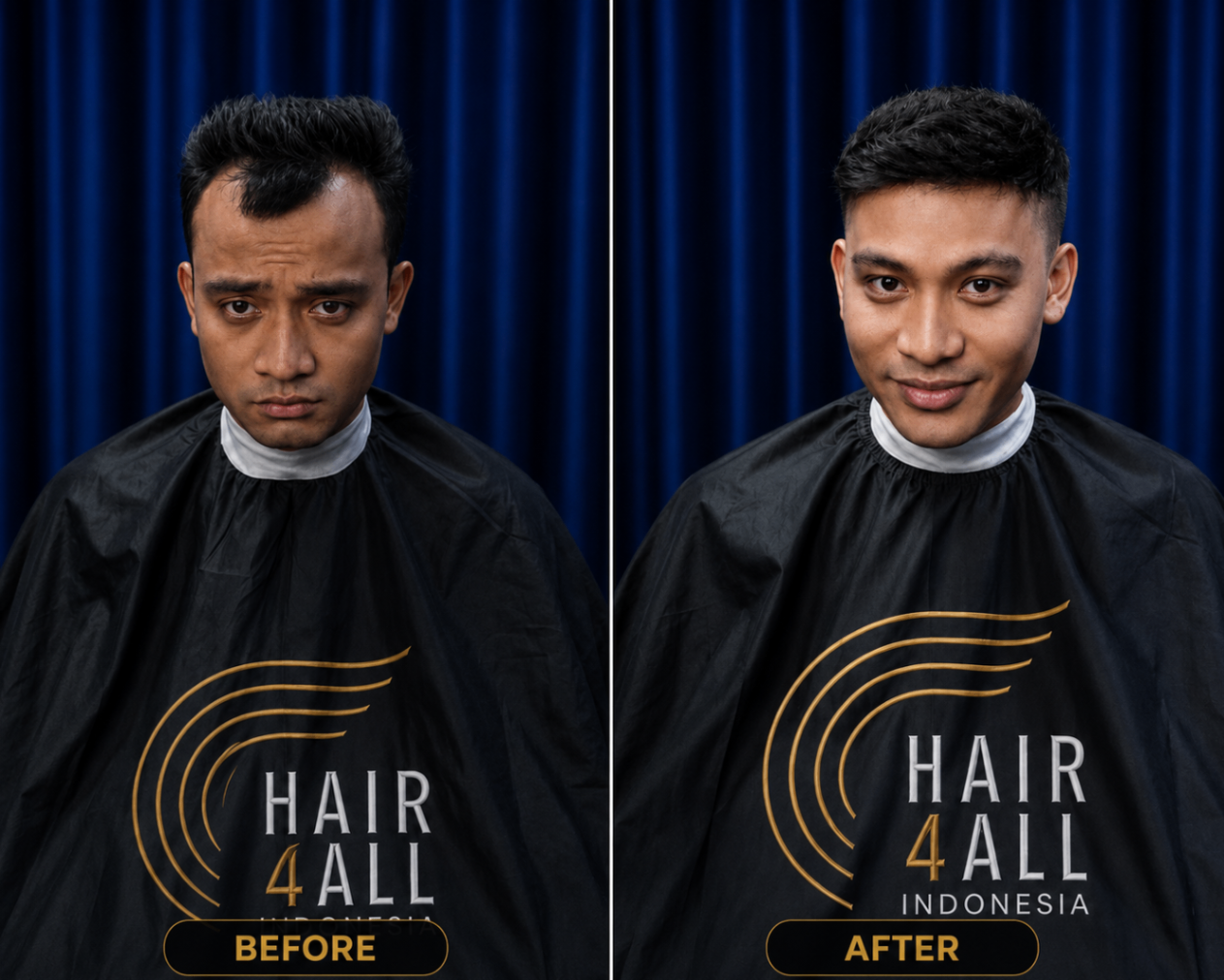 Transformasi klien Hair4All Indonesia 10 — sebelum dan sesudah hair replacement