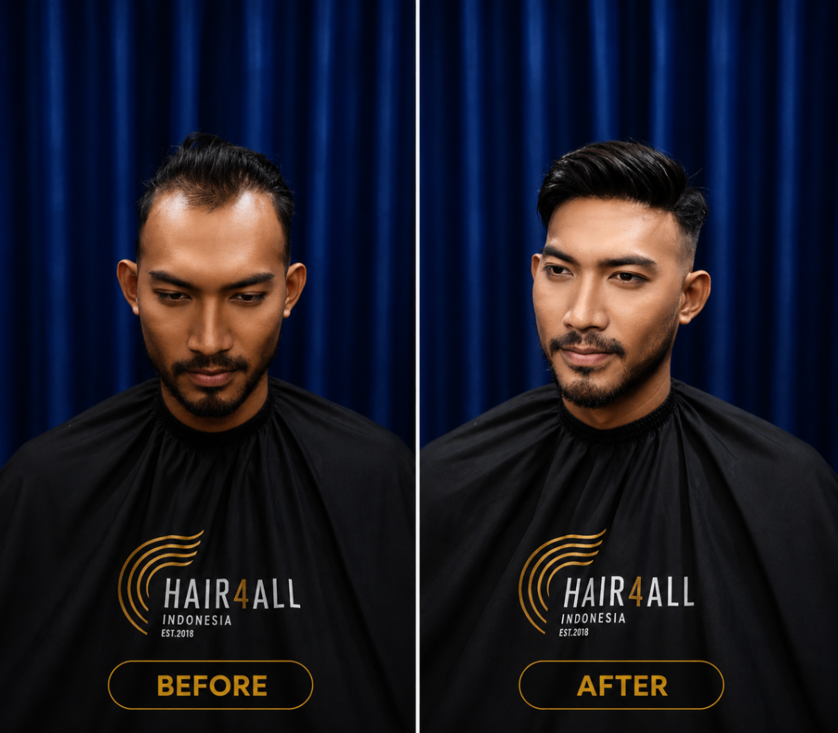 Transformasi klien Hair4All Indonesia 17 — sebelum dan sesudah hair replacement